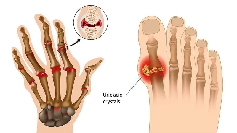 Hình ảnh về bệnh gout giúp nhận biết giai đoạn nặng