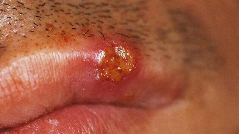 Khám phá triệu chứng qua bệnh hạ cam