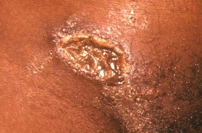 Tổng hợp tư liệu y khoa về ảnh bệnh hạ cam