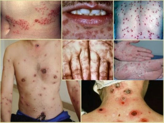 Những điều cần biết về bệnh hạ cam mềm