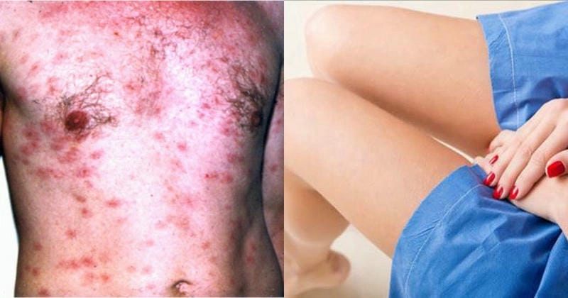 Tìm hiểu triệu chứng qua ảnh người bệnh hạ cam