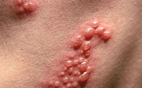 Nhận biết tình trạng qua hình ảnh bị bệnh hạ cam