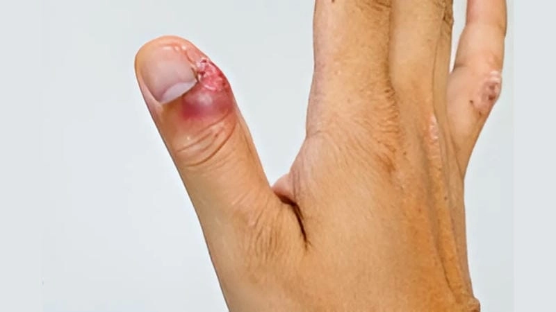 Dấu hiệu nhận biết qua ảnh người bị bệnh hạ cam