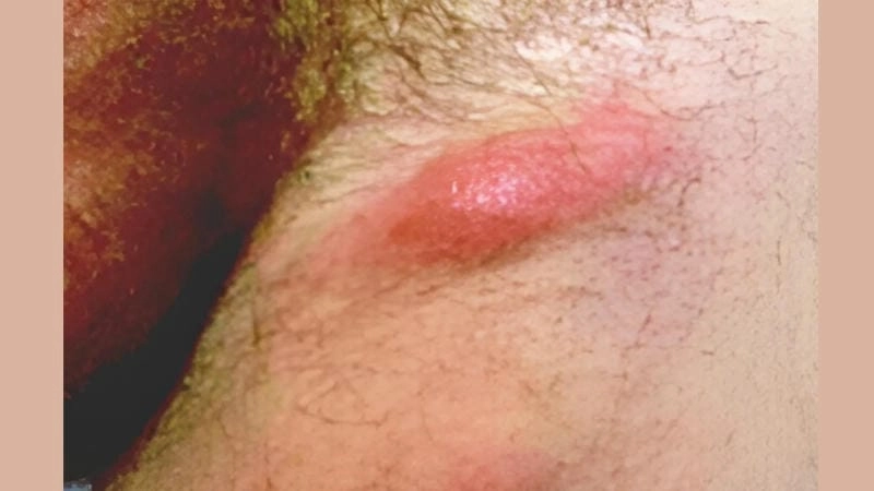 Thông tin sức khỏe liên quan người bệnh hạ cam