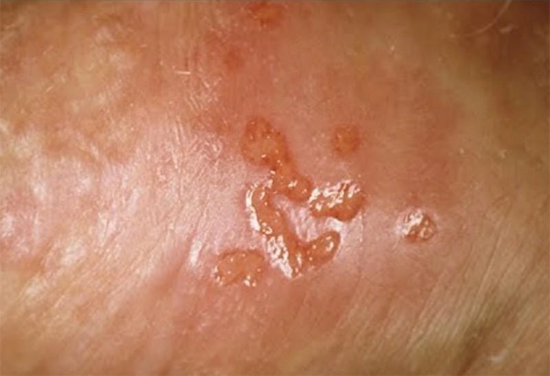 Hình ảnh thực tế từ benh ha cam