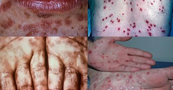 Tổng hợp thực tế rõ nét về ảnh bệnh hạ cam