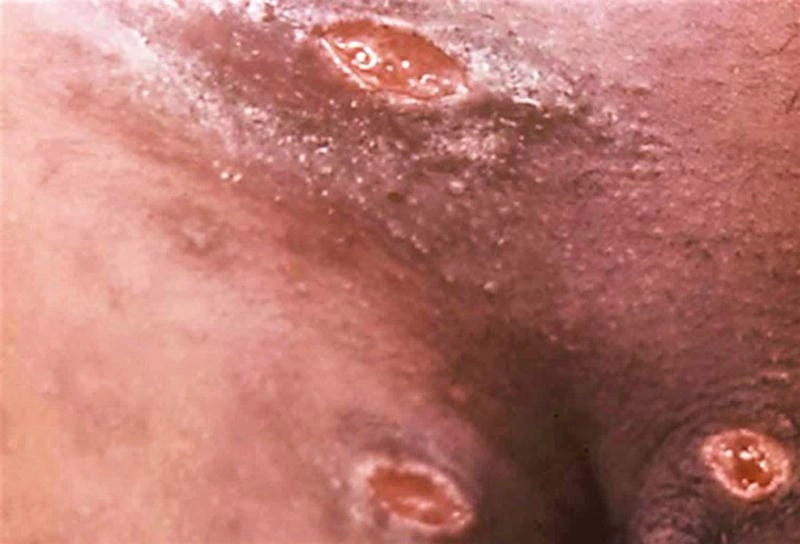 Hiểu rõ biến chứng của bệnh hạ cam mềm