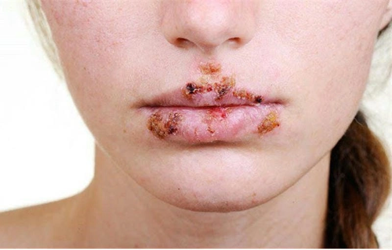 Dấu hiệu sớm cảnh báo bệnh hạ cam ở nam giới