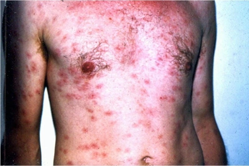 Xem chi tiết tổn thương qua hình ảnh bệnh hạ cam