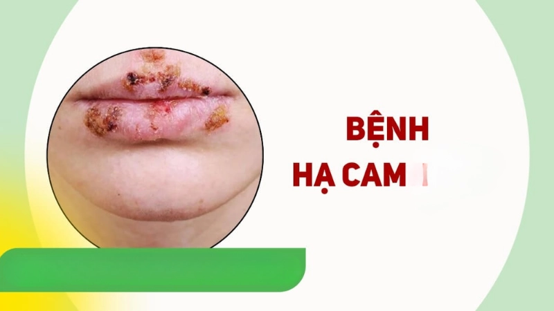 Hình ảnh bệnh hạ cam là như thế nào