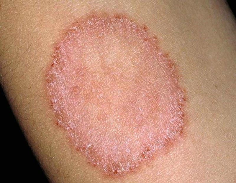 Nguyên nhân phổ biến khiến hắc lào ở mặt dễ tái phát