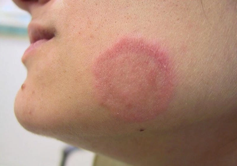 Phân biệt nhanh khi bé bị hắc lào ở mặt dễ lan rộng