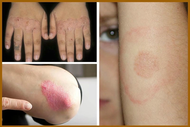 Dấu hiệu dễ thấy khi bị bệnh hắc lào ngoài da