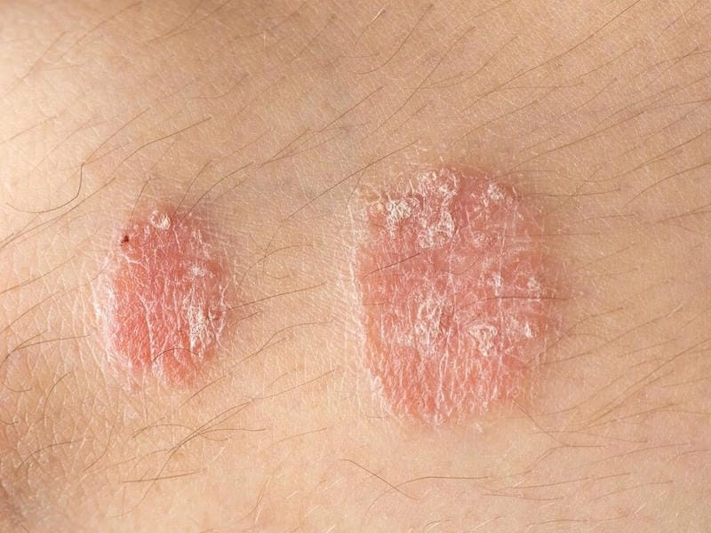 Tổng hợp hình ảnh người bị hắc lào theo vùng da