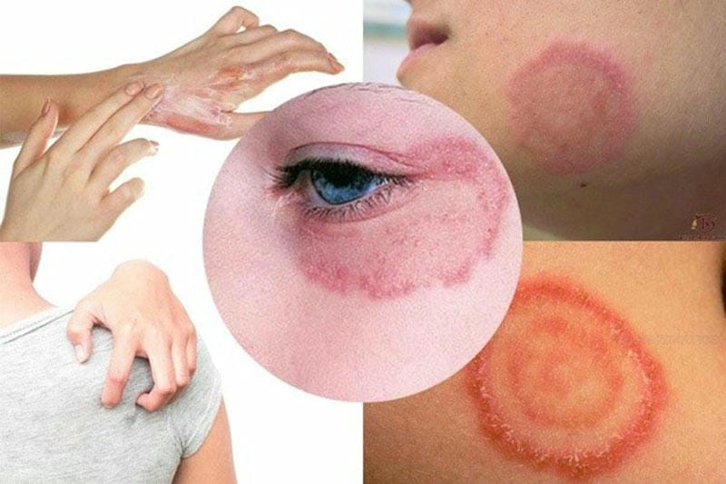 Cha mẹ cần lưu ý khi hắc lào ở trẻ em xuất hiện