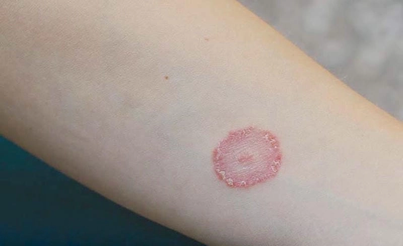 Phát hiện nhanh tình trạng hắc lào mới bị để xử lý