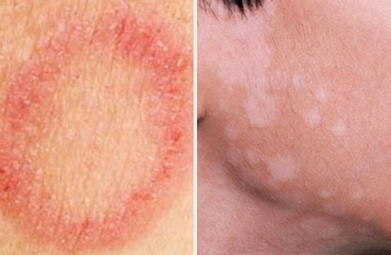 Dấu hiệu điển hình của triệu chứng bệnh hắc lào