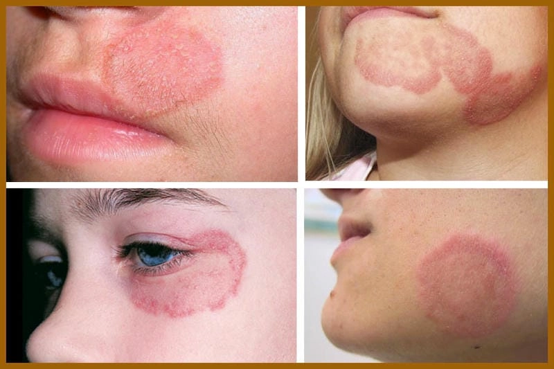 Triệu chứng dai dẳng nếu bị hắc lào lâu năm không chữa