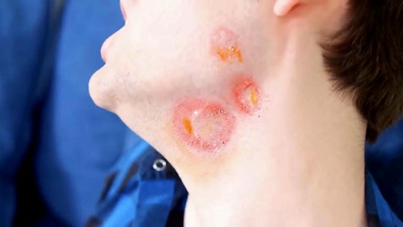 Nguy cơ để lại sẹo nếu bị hắc lào trên mặt kéo dài