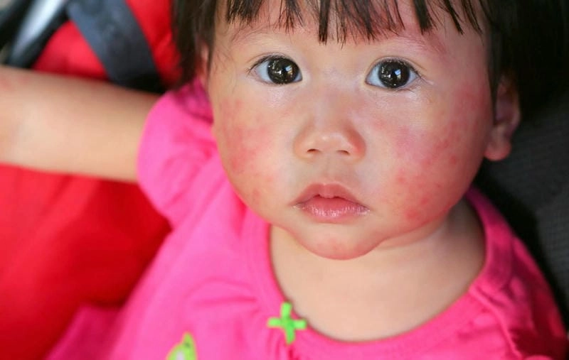 Cập nhật nhanh ảnh hắc lào ở các vùng da thường gặp