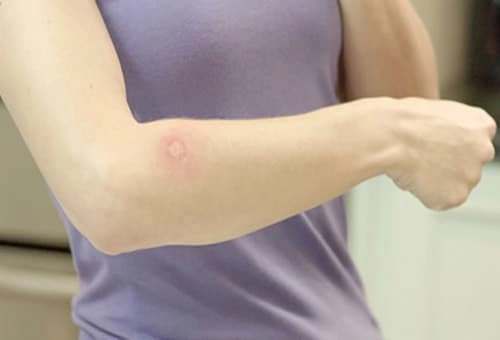 Tìm hiểu kỹ bệnh hắc lào có nguy hiểm không cho trẻ nhỏ