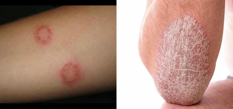 Lý do phổ biến khiến người lớn bị hắc lào dai dẳng