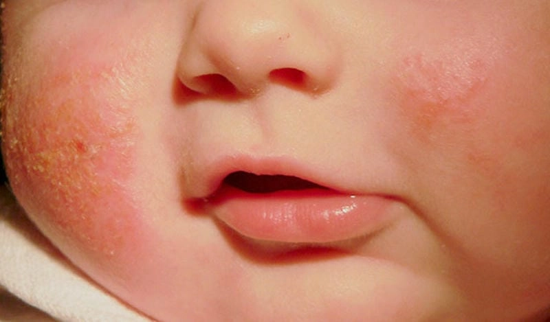 Cách chăm sóc cho người bị hắc lào hiệu quả tại nhà