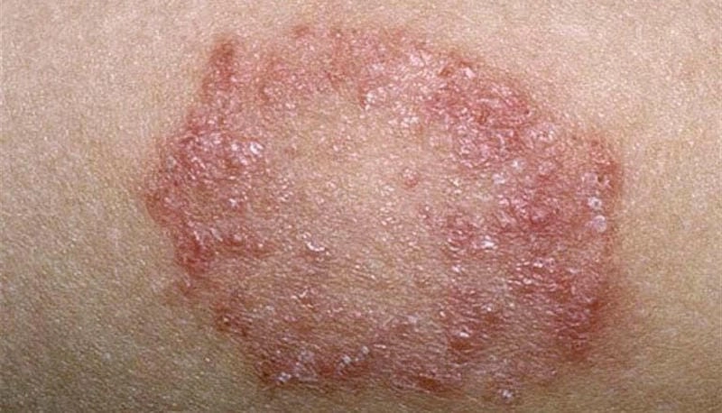 So sánh bệnh hắc lào hình ảnh bệnh ghẻ ngứa chi tiết