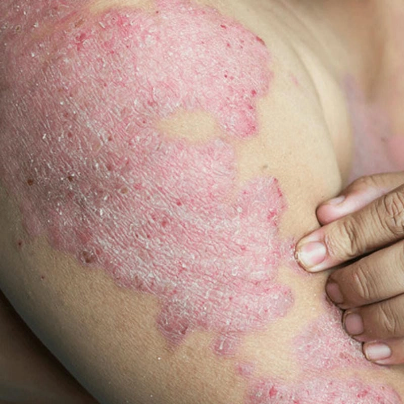 Xem ngay ảnh bị hắc lào thật để phân biệt dễ hơn