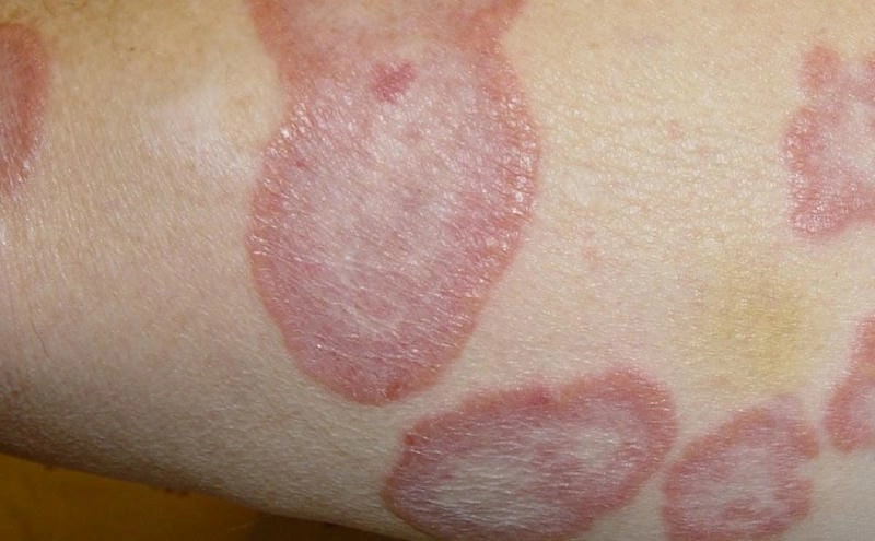 Hướng dẫn phân biệt bệnh hắc lào ghẻ chuẩn xác