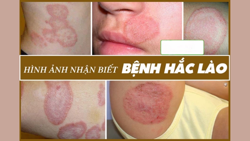Hình ảnh bệnh hắc lào là như thế nào