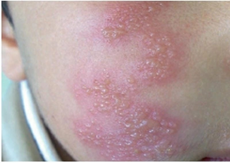 Loạt ảnh cảnh báo bệnh herpes da phổ biến