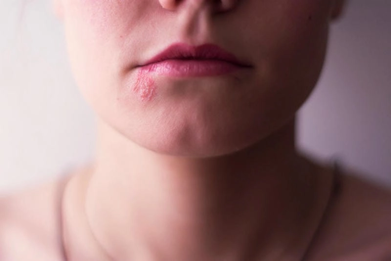 Khám phá hình ảnh bệnh herpes chân thực rõ nét