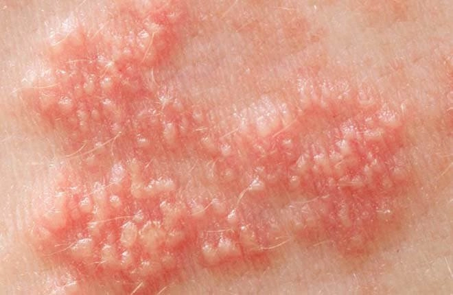 Xem ảnh minh họa về bệnh học herpes trong thực tế