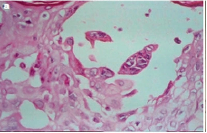 Nhận biết sớm dấu hiệu bệnh herpes trên da