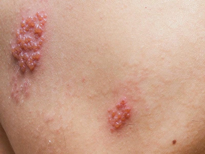 Dấu hiệu đặc trưng dễ thấy của herpes môi