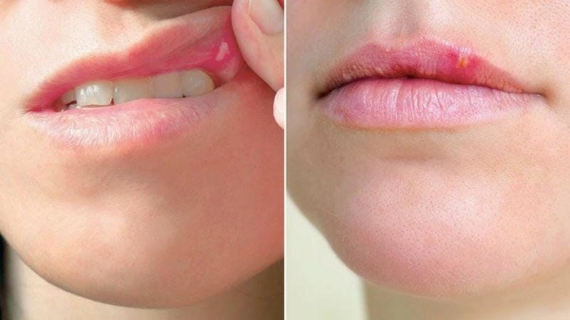 Bạn đang nghi ngờ mình bị herpes môi không