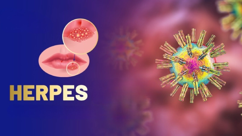 Hình ảnh bệnh herpes là như thế nào