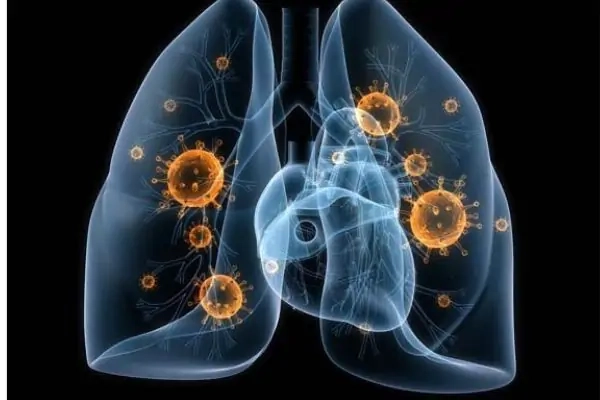 Nguy cơ cao viêm đường hô hấp ở trẻ mỗi năm