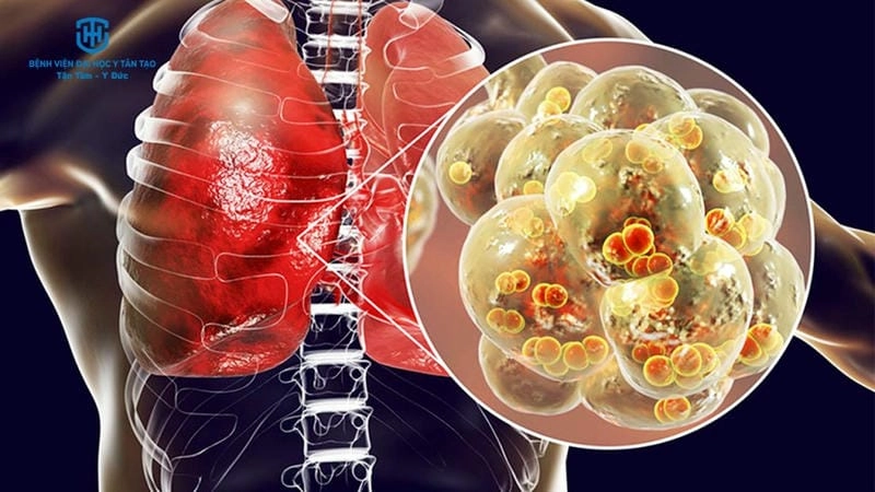 Theo dõi diễn biến viêm đường hô hấp ở trẻ nhỏ