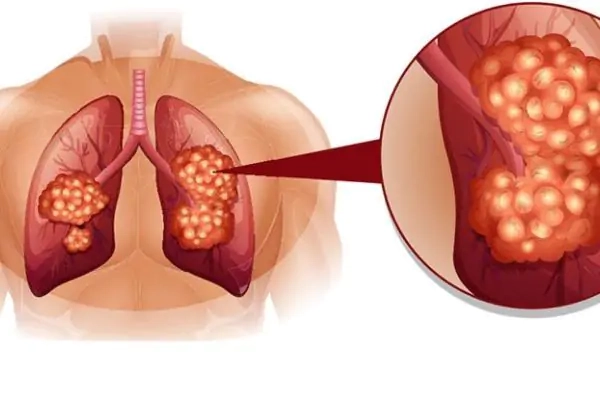 Tình trạng phổ biến viêm đường hô hấp ở trẻ em