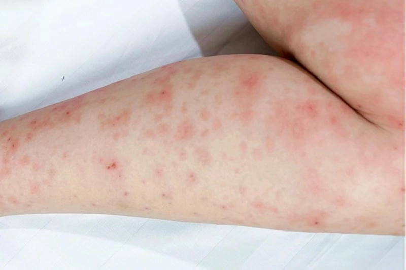 Cập nhật hình ảnh bị bệnh hồng ban đa dạng mới nhất