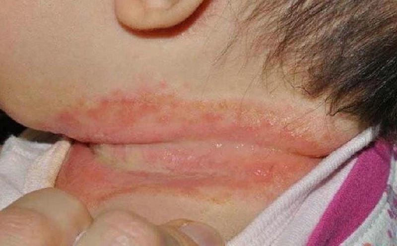 Khám phá ảnh bị bệnh hồng ban đa dạng giúp nhận biết nhanh