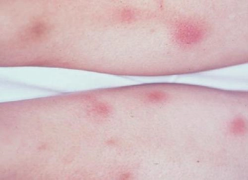 Tìm hiểu hồng ban đa dạng mãn tính và dấu hiệu cảnh báo