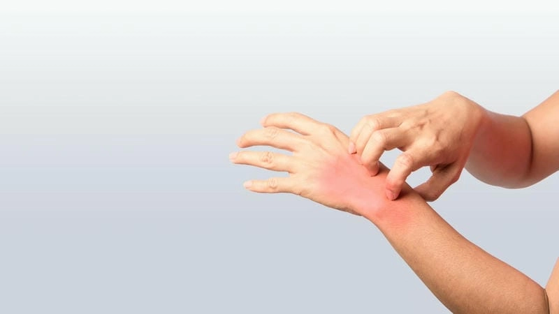 Tìm hiểu ảnh người bệnh hồng ban đa dạng rõ ràng