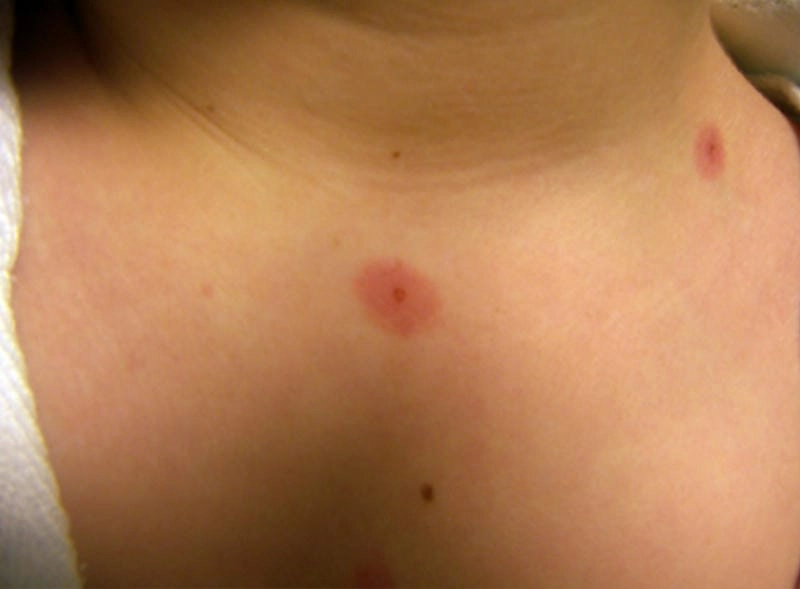 Chi tiết hình ảnh người bệnh hồng ban đa dạng trên cơ thể