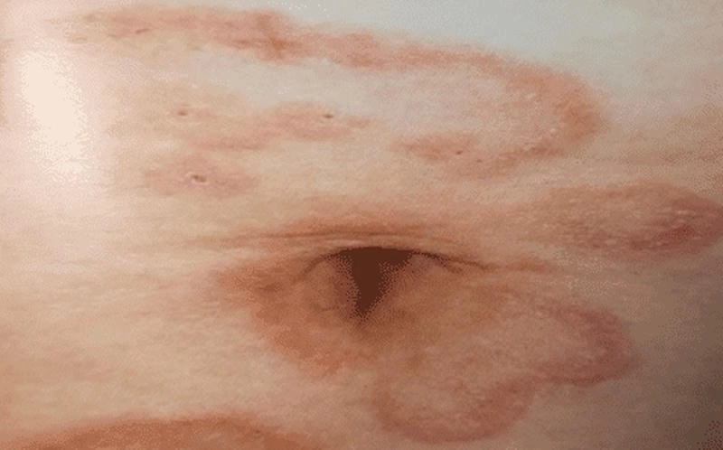 Cập nhật ảnh người bị bệnh hồng ban đa dạng từ chuyên gia