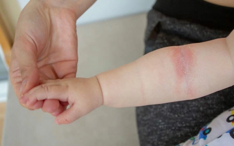 Giải thích triệu chứng bệnh hồng ban đa dạng có lây không cụ thể