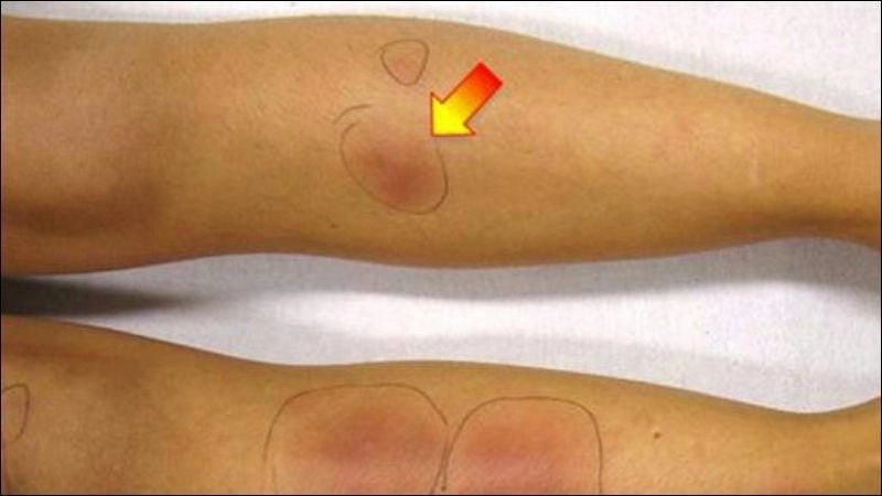 Thông tin nguyên nhân bệnh hồng ban đa dạng có lây không chi tiết