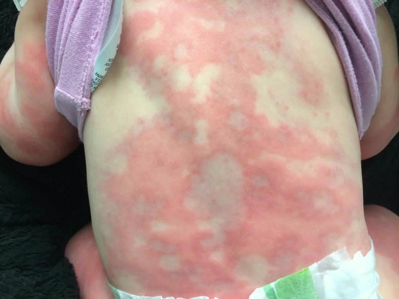 Khám phá cách điều trị bệnh hồng ban đa dạng hiệu quả